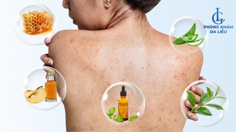 sử dụng sản phẩm thiên nhiên trị mụn lưng