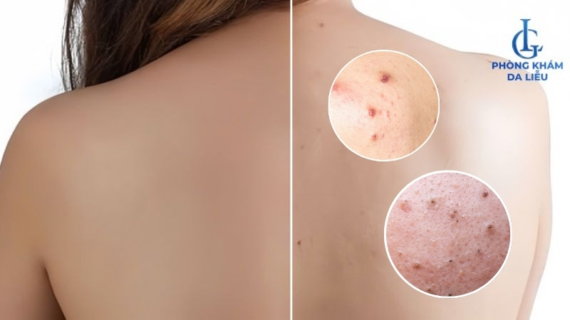 trị mụn lưng trong 1 tuần