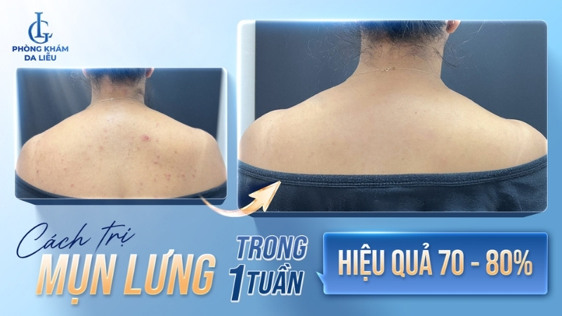 cách trị mụn lưng trong 1 tuần