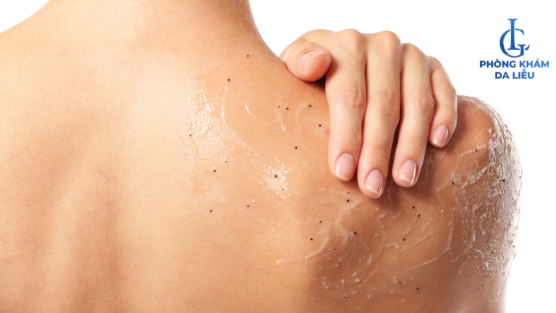 tẩy tế bào chế trị mụn lưng 1 tuần