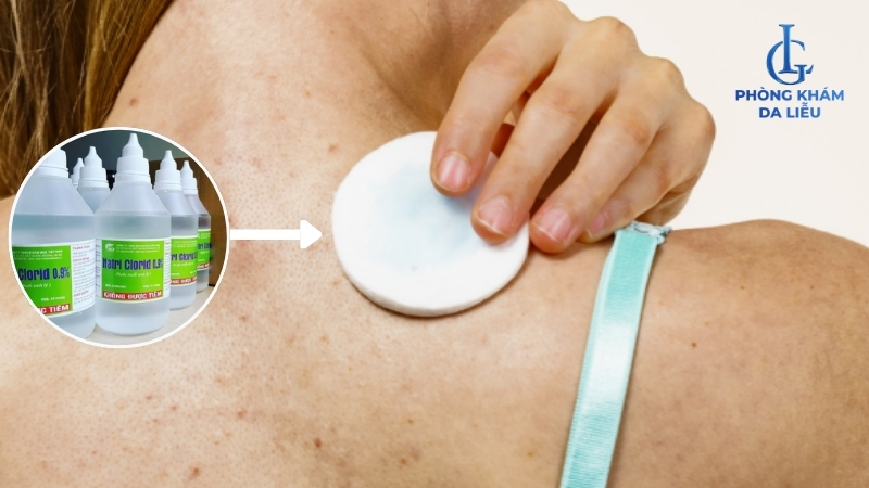 nước muối pha loãng trị mụn lưng