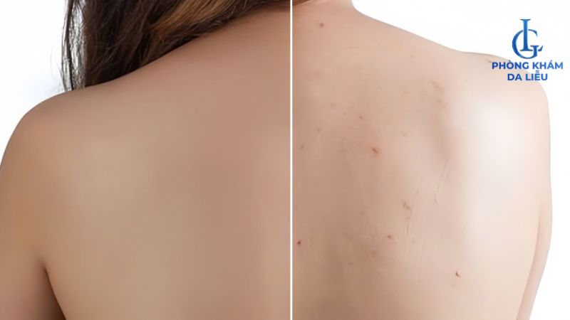 cách trị mụn lưng