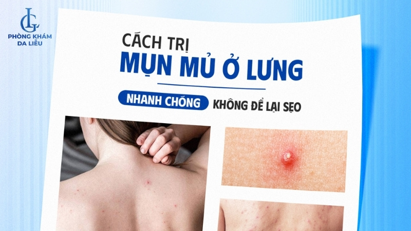 cách trị mụn mủ ở lưng