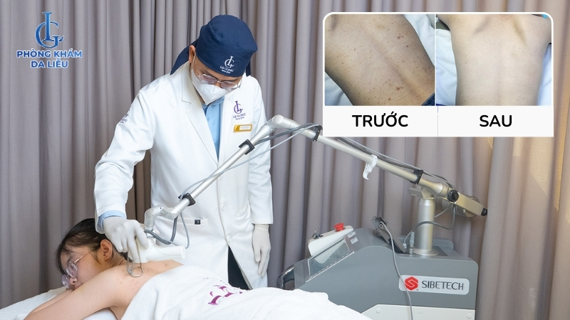 điều trị mụn mủ ở lưng