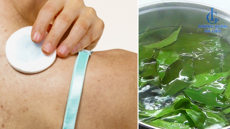 cách trị mụn ở ngực và lưng tại nhà