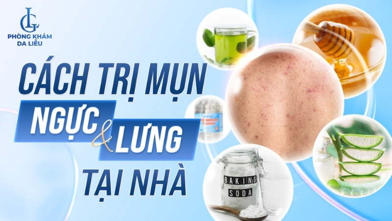 cách trị mụn ở ngực và lưng tại nhà