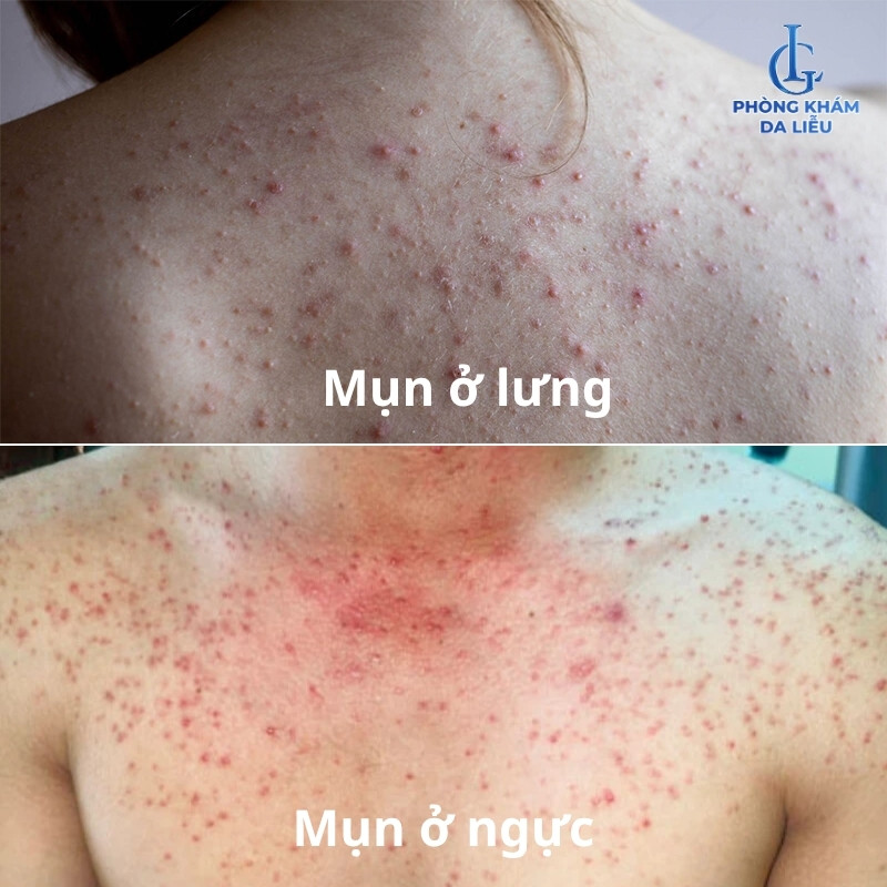 Mụn ở ngực và lưng