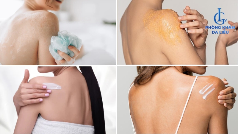 cách trị mụn ở ngực và lưng tại nhà