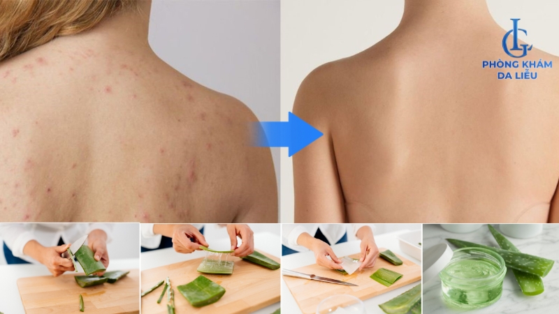 trị nổi mụn ở ngực và lưng
