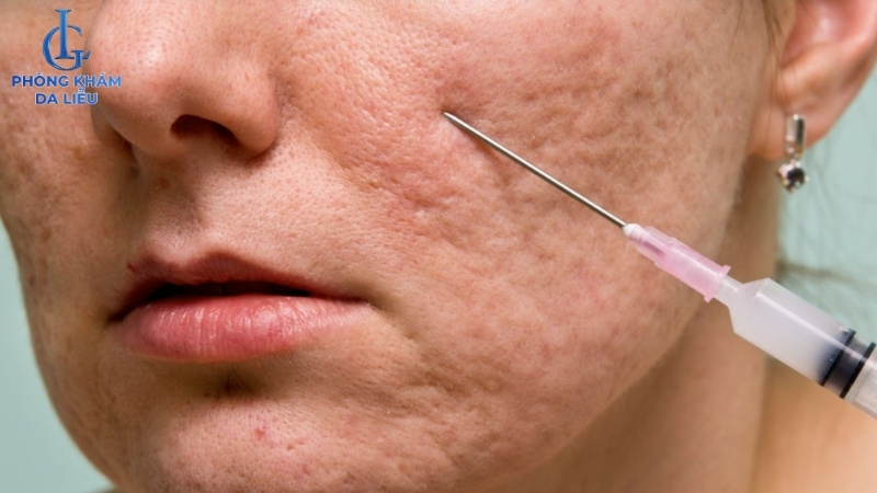 cắt đáy sẹo rỗ