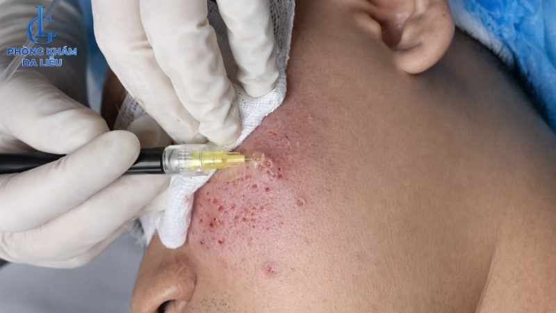 cắt đáy sẹo rỗ bằng khí co2