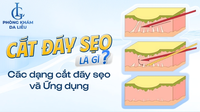 cắt đáy sẹo rỗ là gì