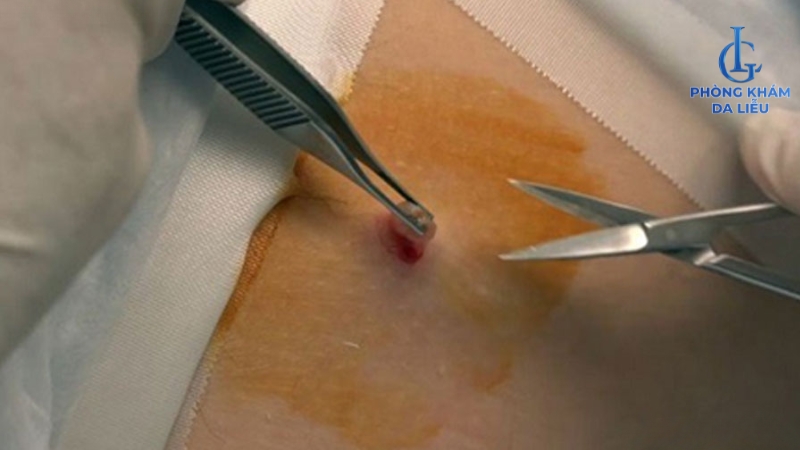 cắt mụn thịt ở lưng