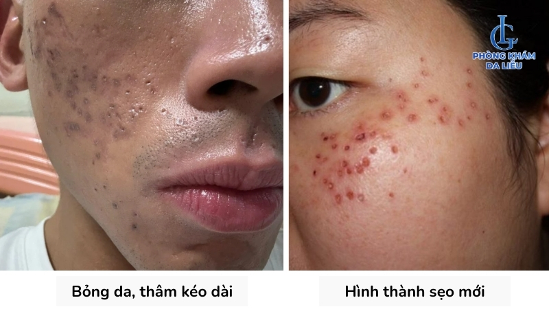 thâm, bỏng da sẹo rỗ