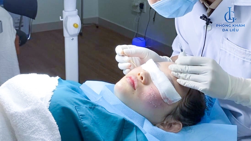 Chấm tca trị sẹo rỗ tại phòng khám