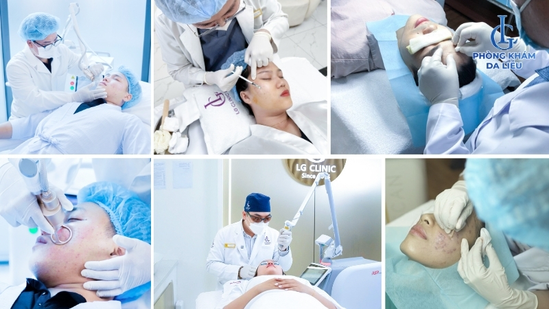 Trị sẹo rỗ đa phương pháp