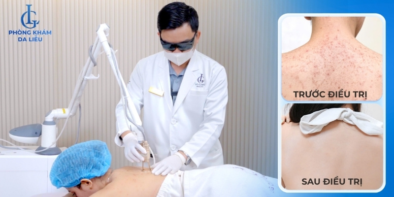 điều trị mụn đầu đen ở lưng bằng công nghệ cao