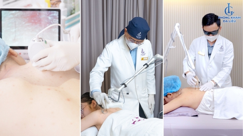 điều trị mụn lưng bằng công nghệ cao