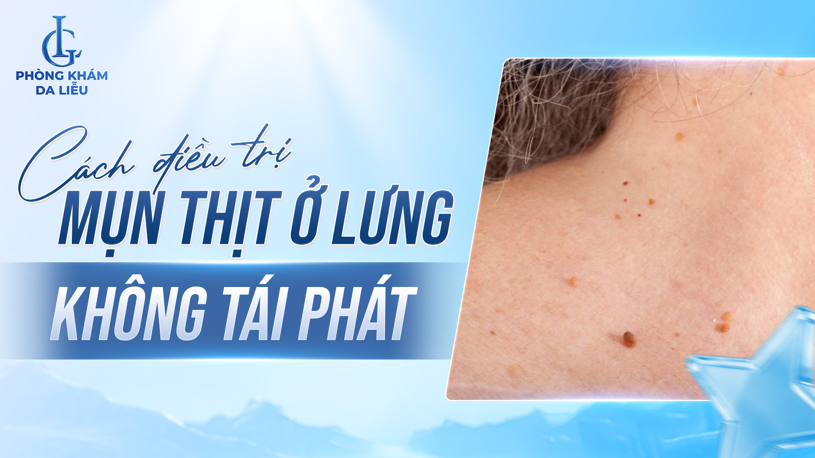 điều trị mụn thịt ở lưng
