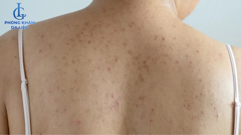 hình ảnh mụn thâm ở lưng