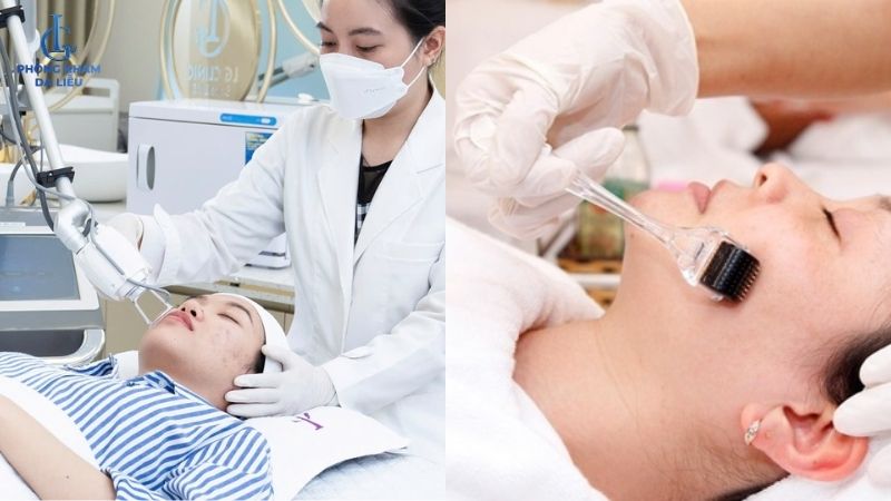 kết hợp lăn kim trị sẹo