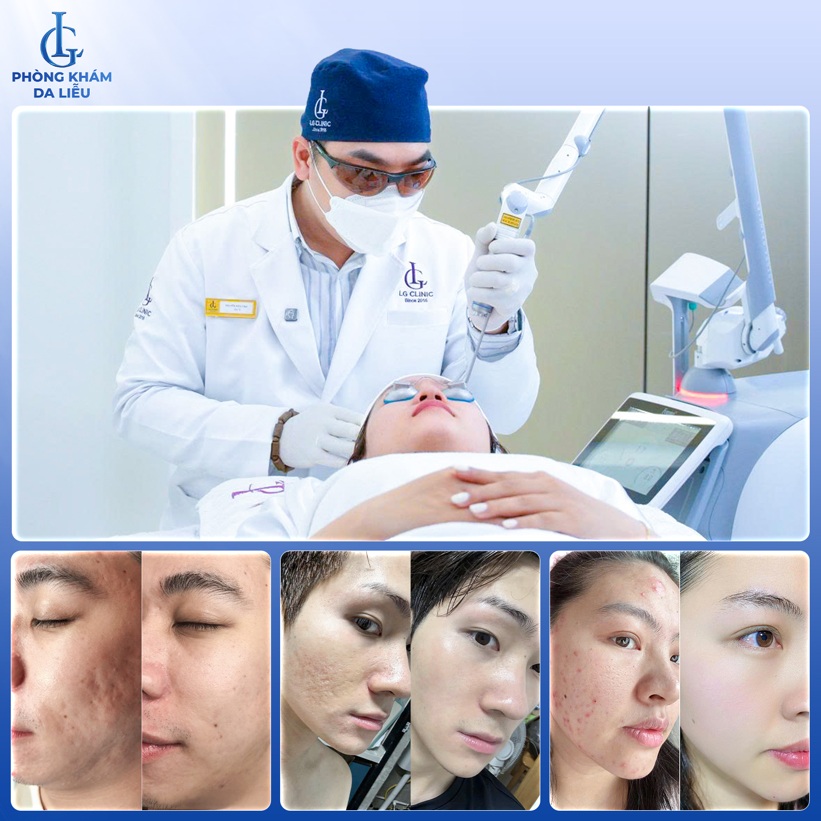 sẹo rỗ có trị được không