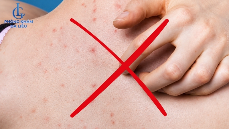 không tự ý cạy nặn tránh mụn thâm ở lưng nổi thêm