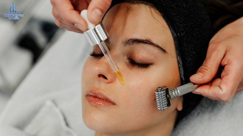 Lăn kim trị sẹo rỗ giá bao nhiêu