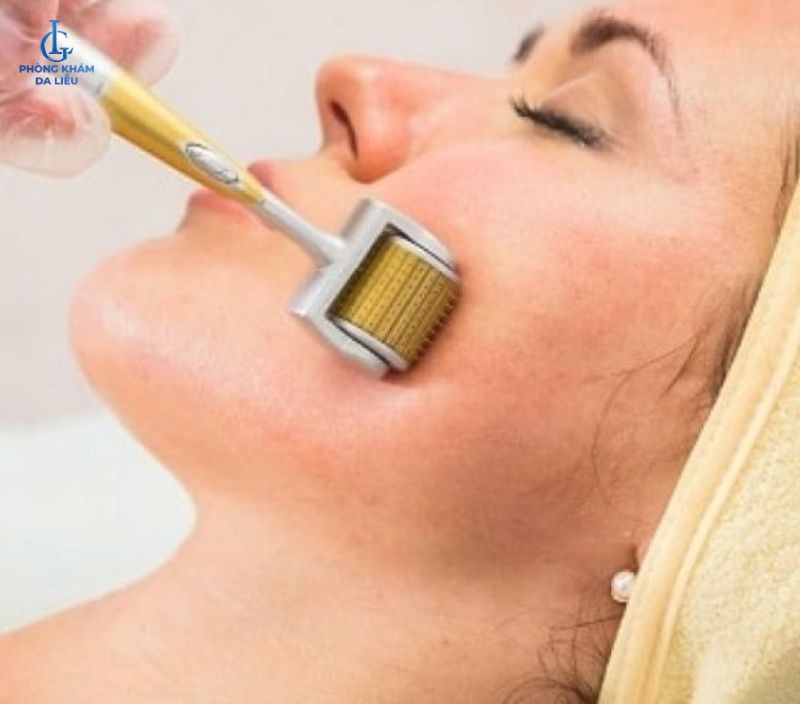 lăn kim trị sẹo rỗ giá bao nhiêu