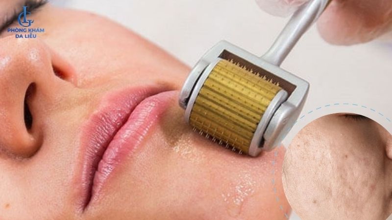 lăn kim trị sẹo 