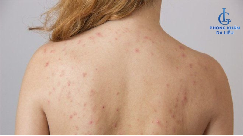 lưng nổi mụn đỏ