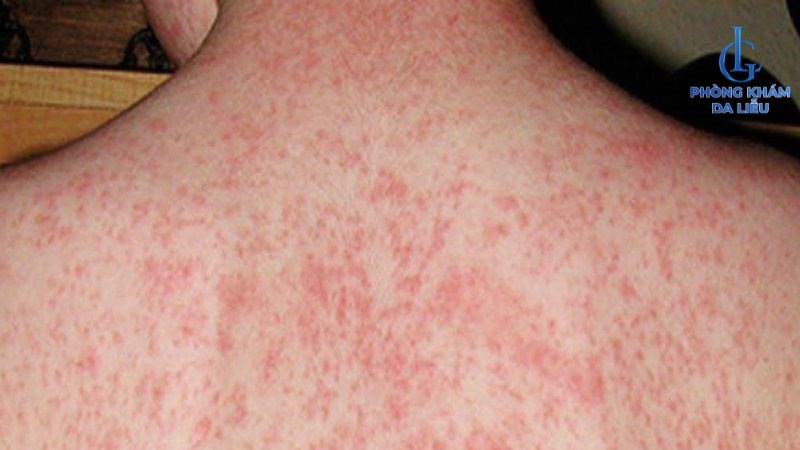 lưng nổi mẩn đỏ
