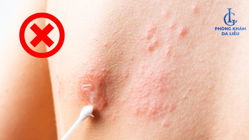 lưng nổi mụn đỏ