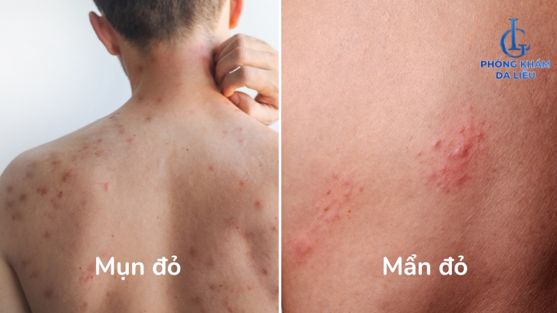 mẩn đỏ do bệnh