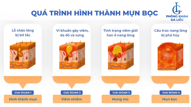 mụn bọc ở lưng