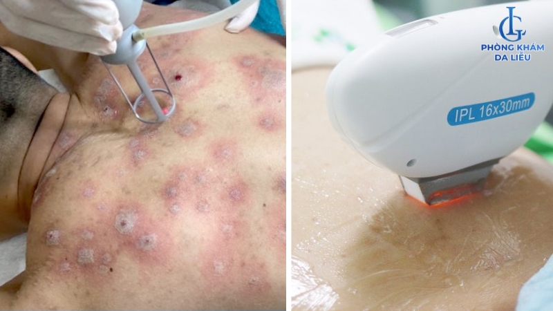 công nghệ trị mụn bọc ở lưng