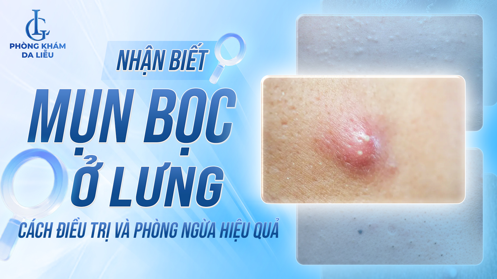 mụn bọc ở lưng