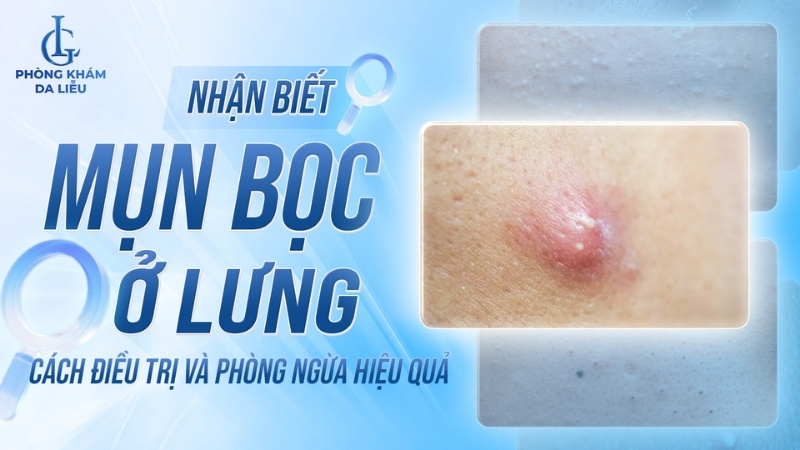 mụn bọc ở lưng