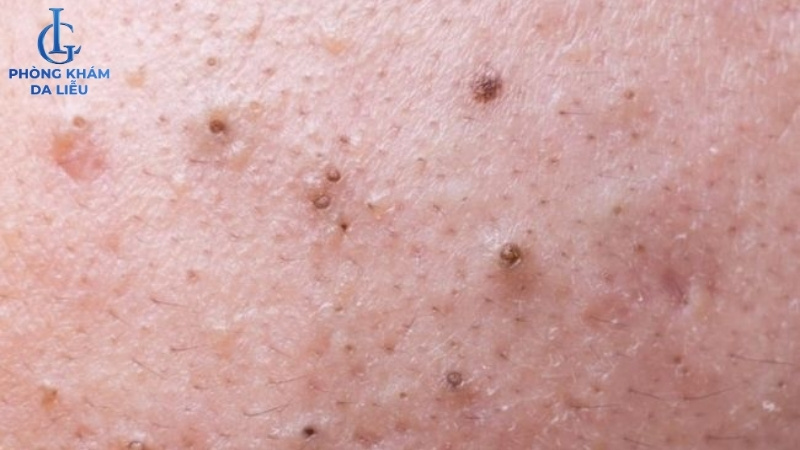 mụn đầu đen ở lưng là gì