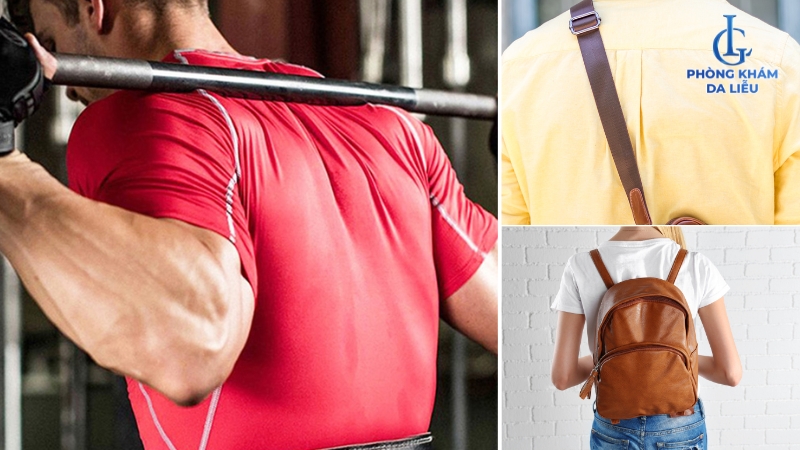 mụn vùng lưng và vai