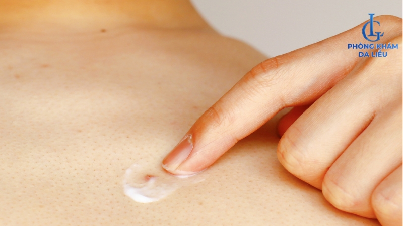 bôi thuốc mụn thịt ở lưng