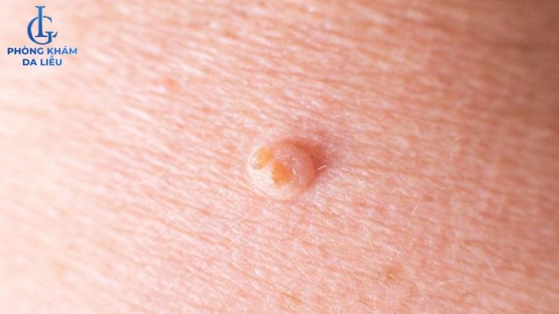 mụn thịt ở lưng