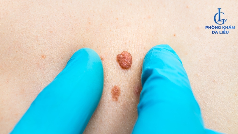 mụn thịt ở lưng