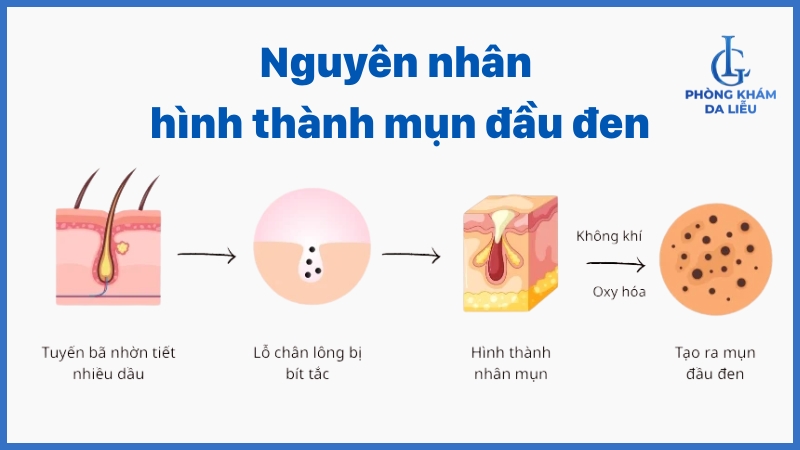 nguyên nhân mụn đầu đen ở lưng