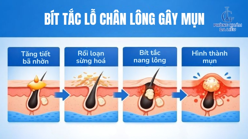 hình thành nổi mụn ở lưng và vai