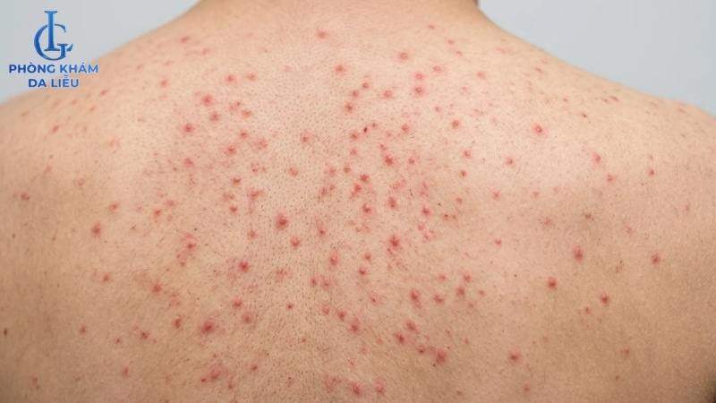 nổi mẫn đỏ ở lưng nguyên nhân do viêm nang lông