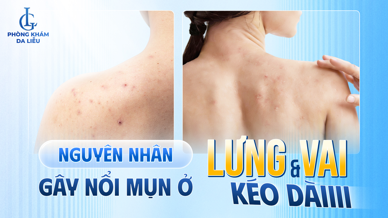 nổi mụn ở lưng và vai