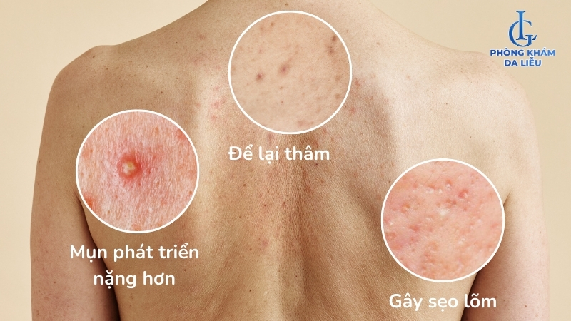 nổi mụn ở lưng và vai