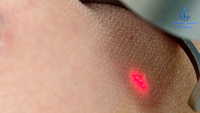 Laser Co2 trị mụn thịt ở lưng