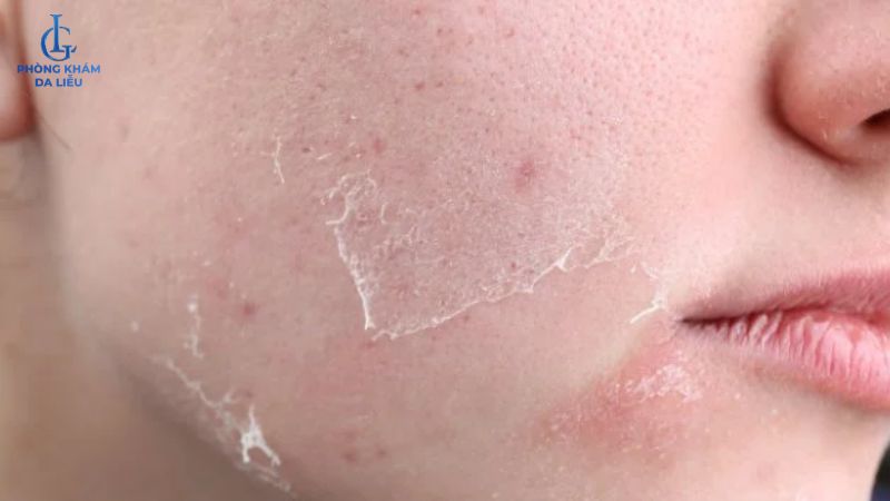 sẹo rỗ nhẹ có hết không